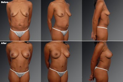 Tummy Tuck Before & After Gallery - Patient 105798918 - Image 1