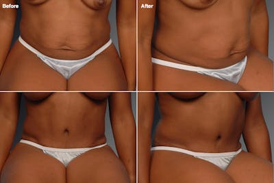 Tummy Tuck Before & After Gallery - Patient 105836387 - Image 1