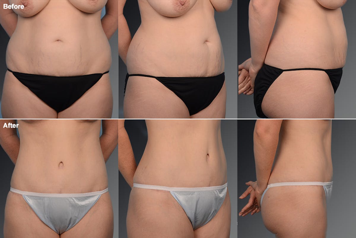 Tummy Tuck Before & After Gallery - Patient 105836388 - Image 1