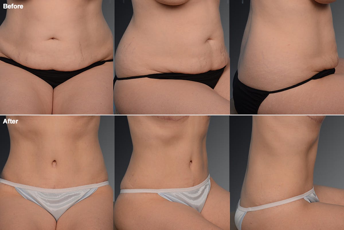 Tummy Tuck Before & After Gallery - Patient 105836389 - Image 1