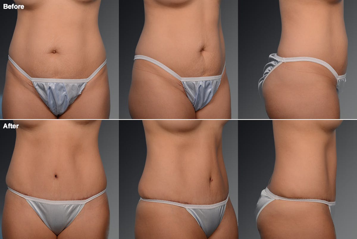 Tummy Tuck Before & After Gallery - Patient 105836390 - Image 1