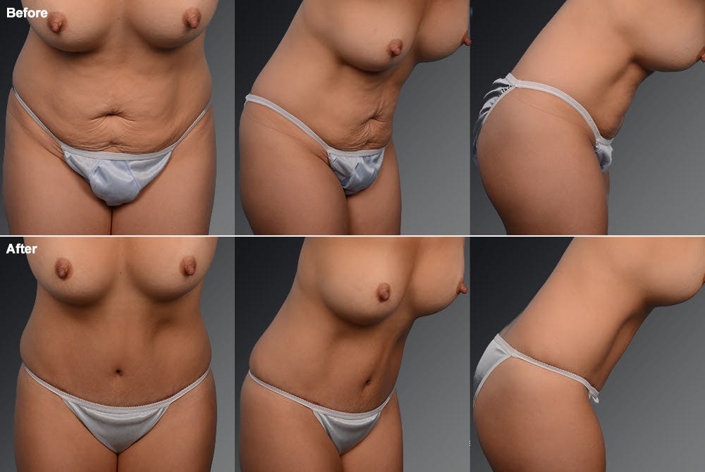 Tummy Tuck Before & After Gallery - Patient 105836391 - Image 1