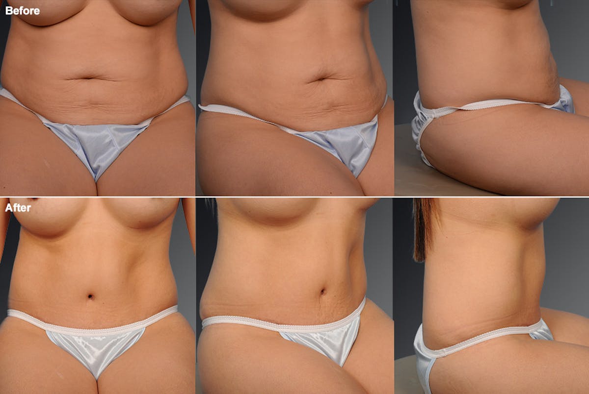Tummy Tuck Before & After Gallery - Patient 105836392 - Image 1