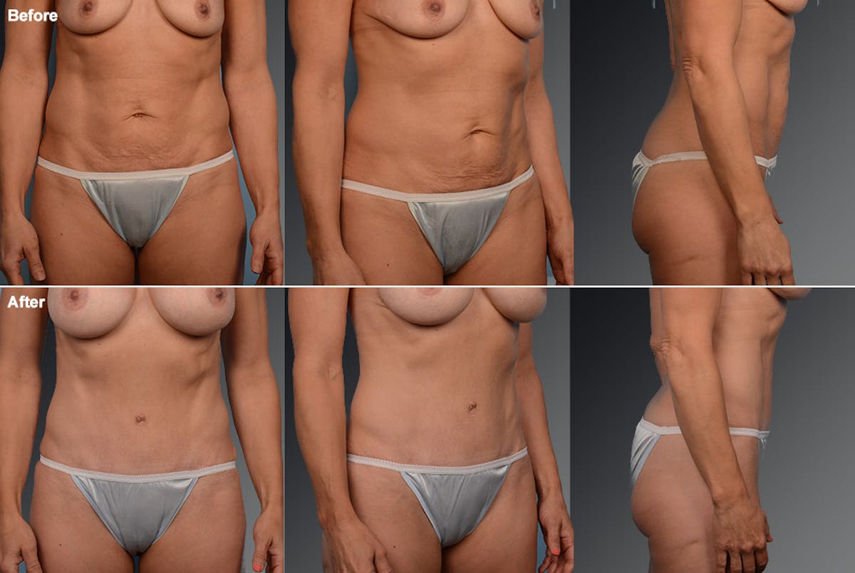 Tummy Tuck Before & After Gallery - Patient 105836393 - Image 1
