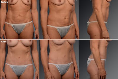 Tummy Tuck Before & After Gallery - Patient 105836393 - Image 1
