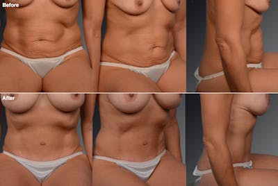 Tummy Tuck Before & After Gallery - Patient 105836394 - Image 1