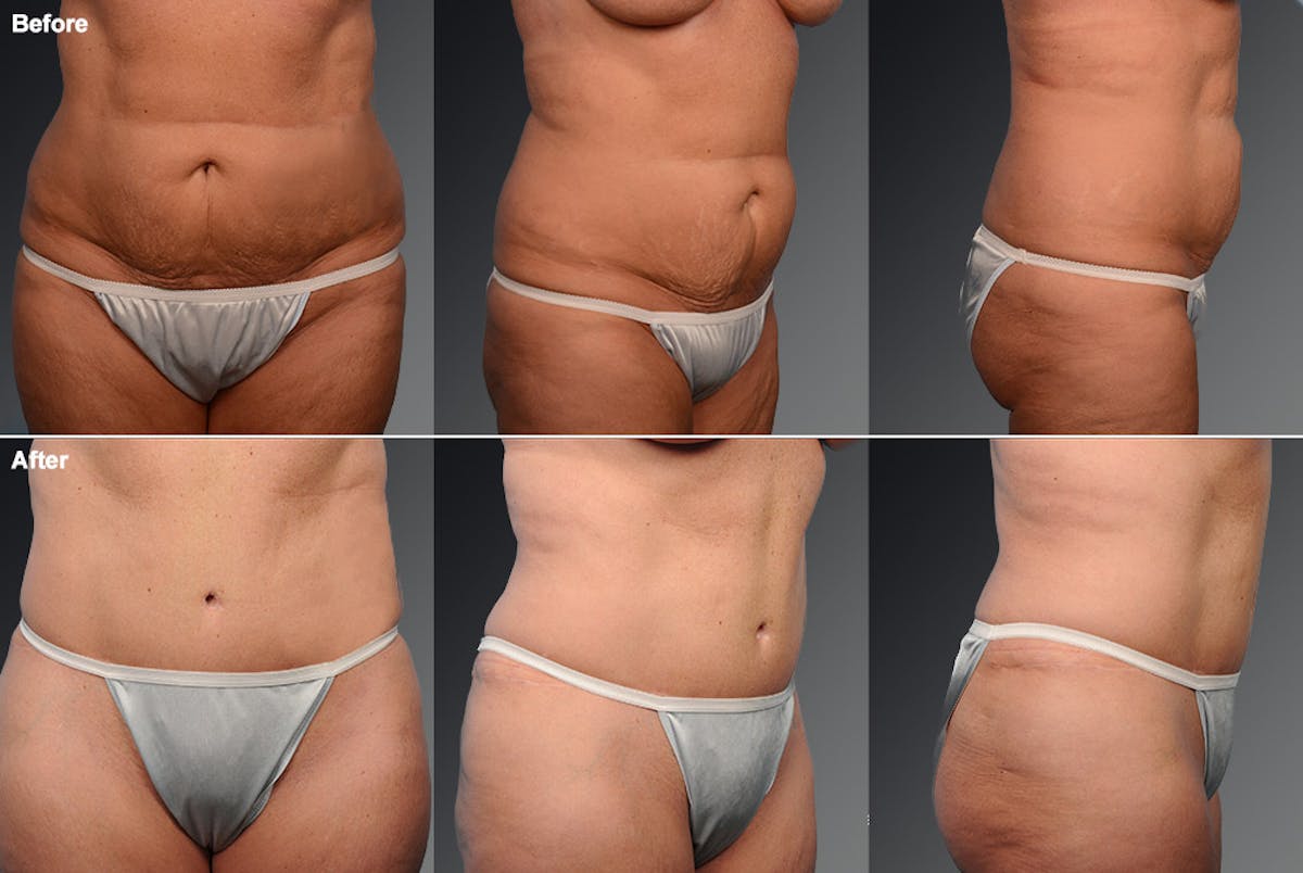 Tummy Tuck Before & After Gallery - Patient 105836395 - Image 1