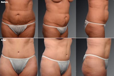 Tummy Tuck Before & After Gallery - Patient 105836395 - Image 1