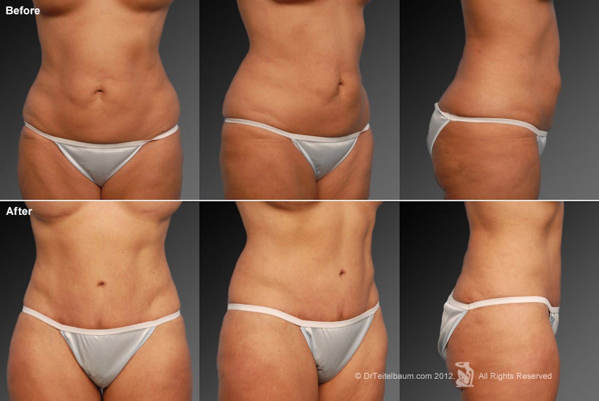 Tummy Tuck Before & After Gallery - Patient 105836396 - Image 1