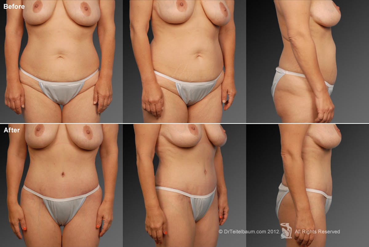 Tummy Tuck Before & After Gallery - Patient 105836399 - Image 1