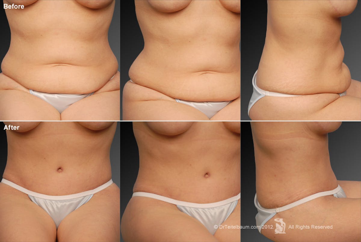 Tummy Tuck Before & After Gallery - Patient 105836402 - Image 1