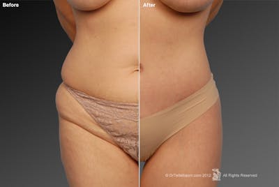 Tummy Tuck Before & After Gallery - Patient 105836403 - Image 1