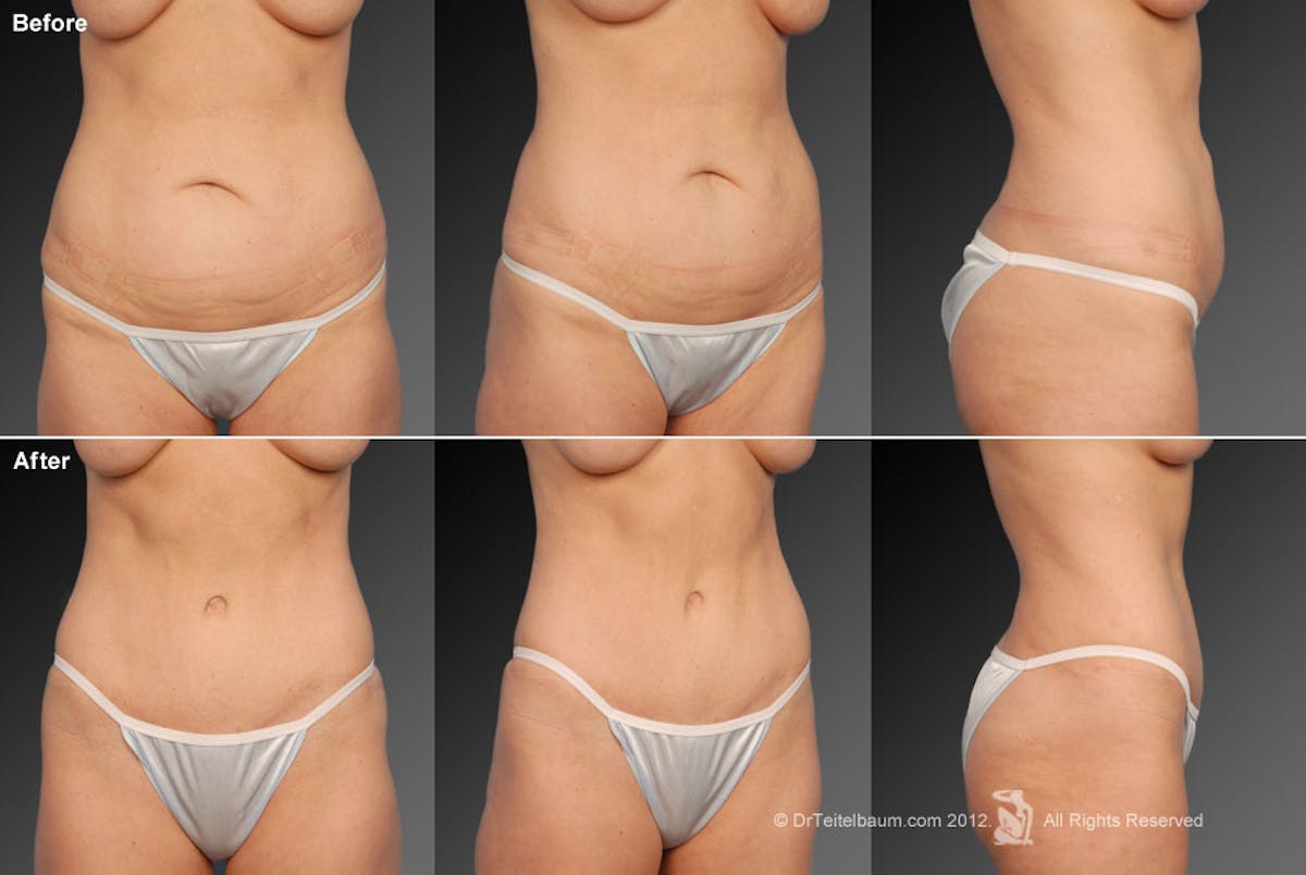 Tummy Tuck Before & After Gallery - Patient 105836404 - Image 1