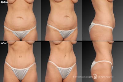 Tummy Tuck Before & After Gallery - Patient 105836404 - Image 1