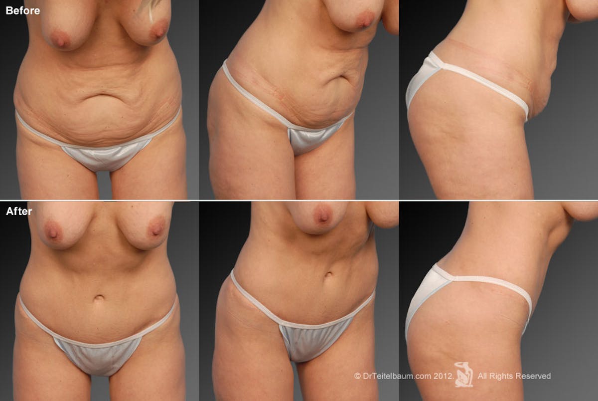 Tummy Tuck Before & After Gallery - Patient 105836405 - Image 1