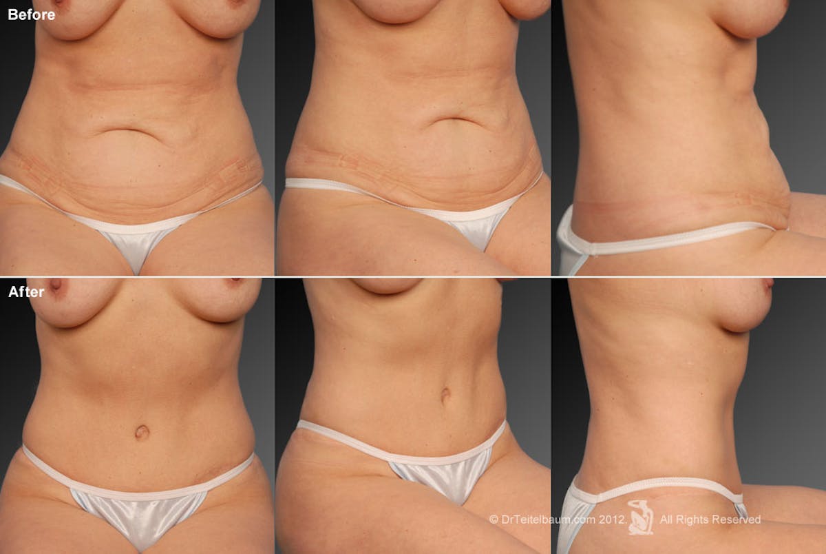 Tummy Tuck Before & After Gallery - Patient 105836406 - Image 1