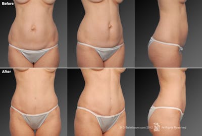 Tummy Tuck Before & After Gallery - Patient 105836407 - Image 1