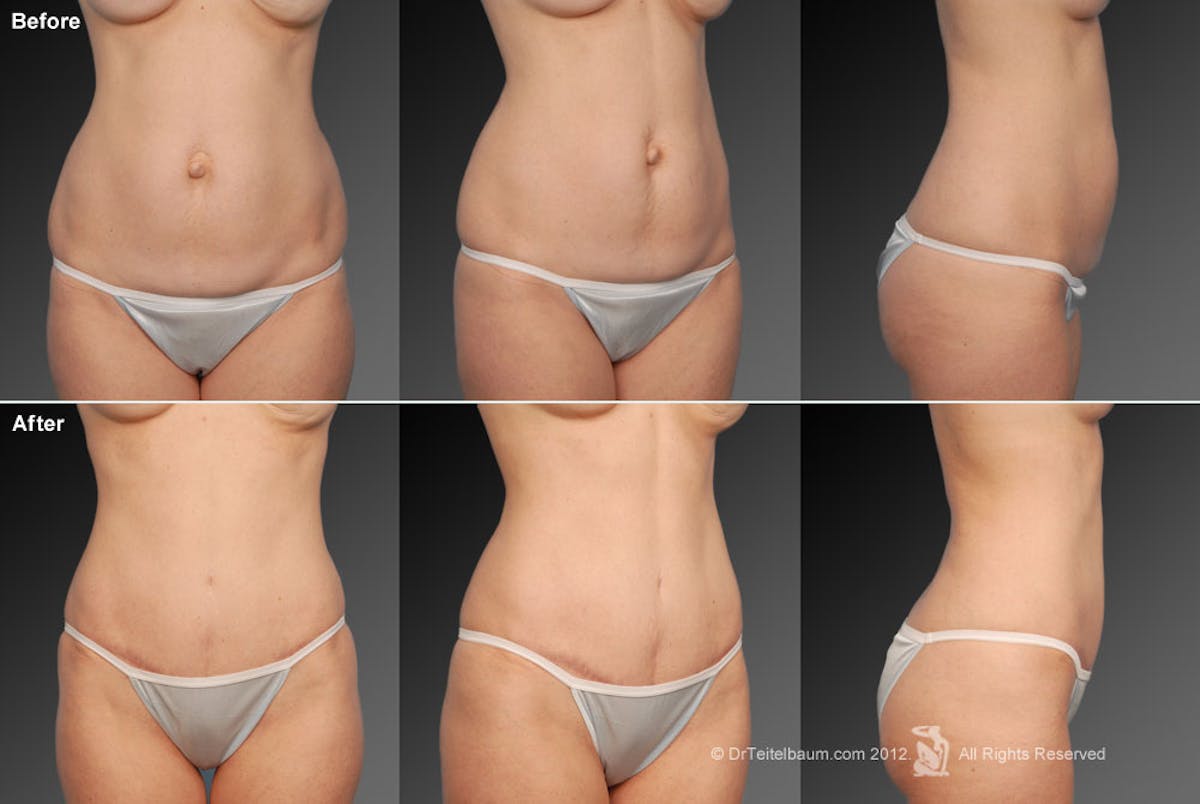 Tummy Tuck Before & After Gallery - Patient 105836407 - Image 1