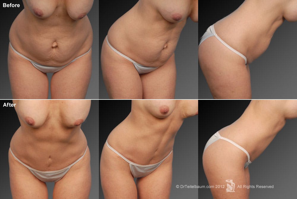Tummy Tuck Before & After Gallery - Patient 105836408 - Image 1