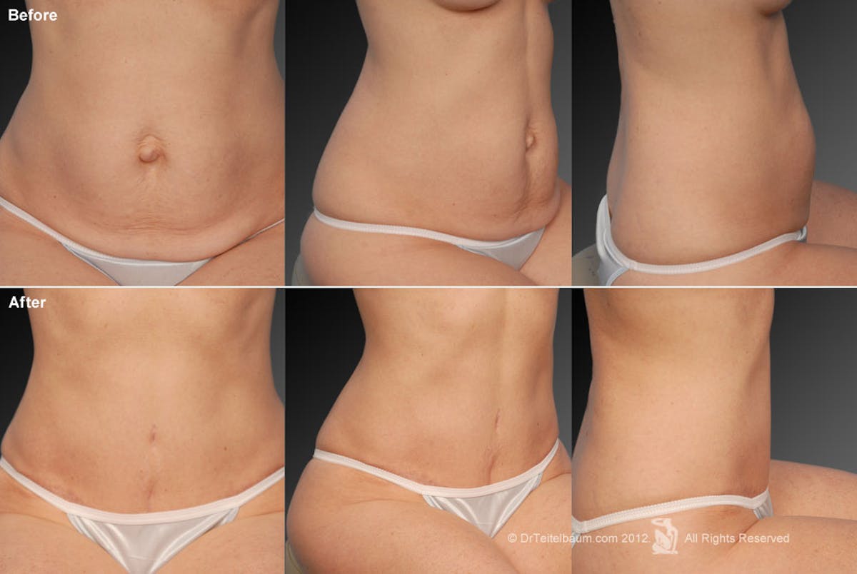 Tummy Tuck Before & After Gallery - Patient 105836409 - Image 1
