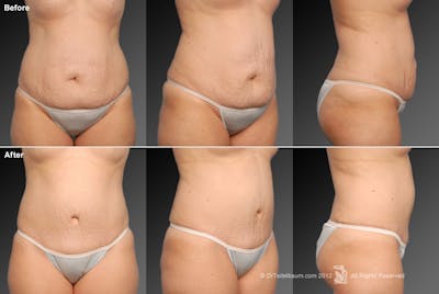 Tummy Tuck Before & After Gallery - Patient 105836410 - Image 1
