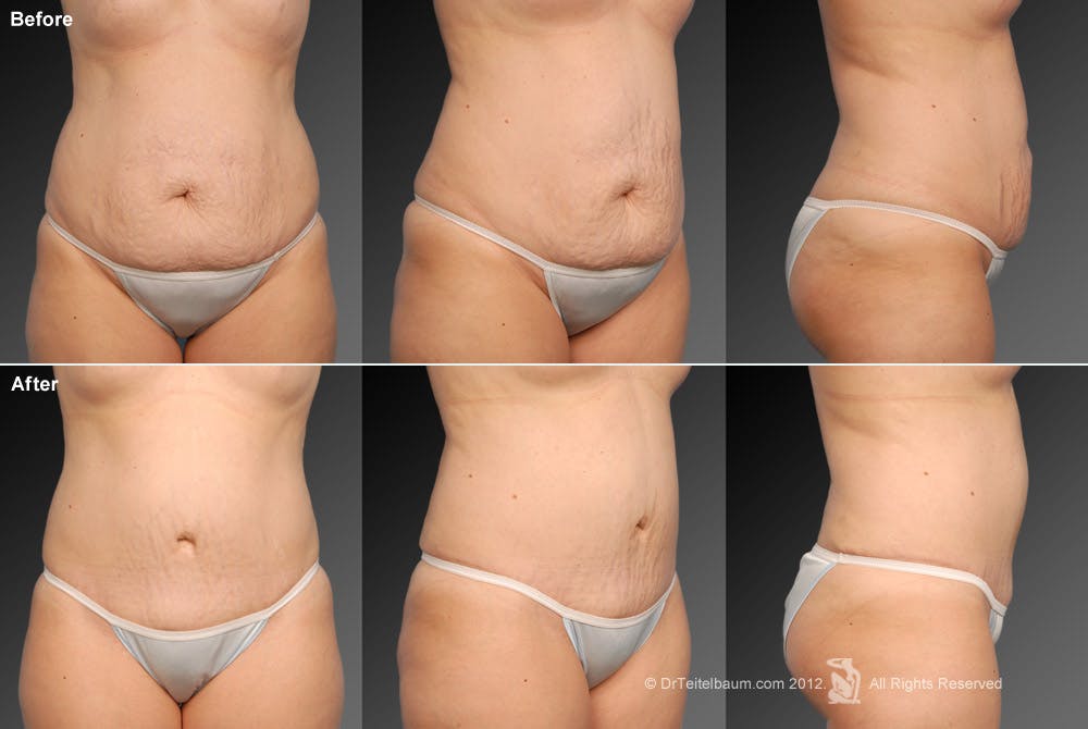 Tummy Tuck Before & After Gallery - Patient 105836410 - Image 1
