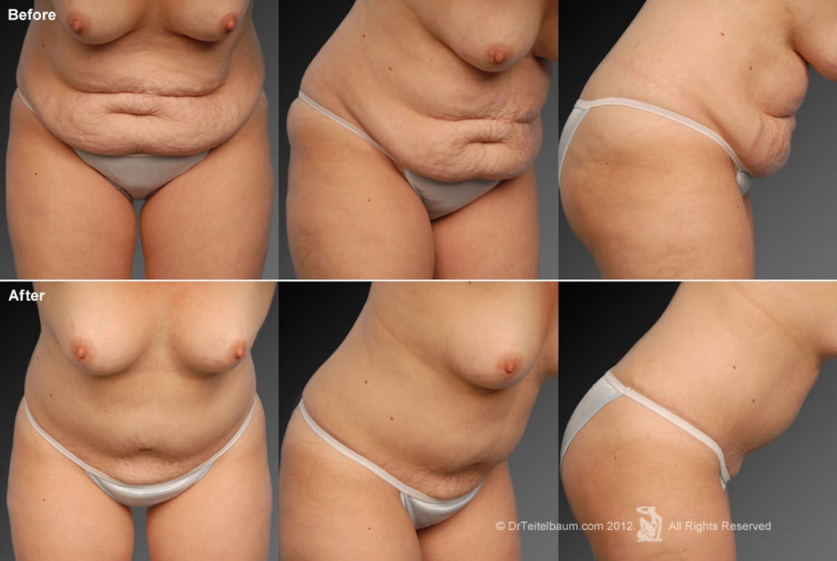 Tummy Tuck Before & After Gallery - Patient 105836412 - Image 1