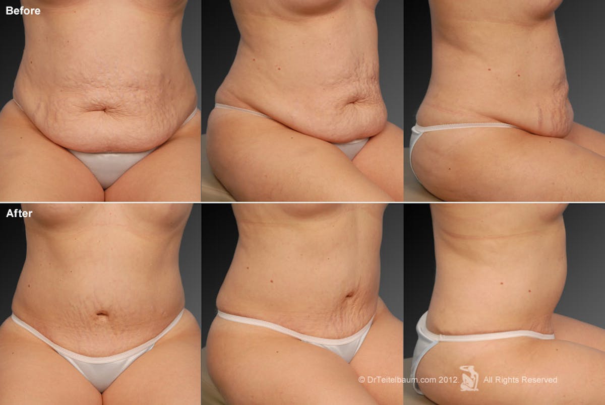 Tummy Tuck Before & After Gallery - Patient 105836413 - Image 1