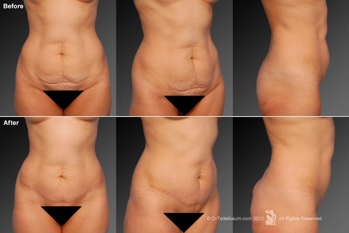 Tummy Tuck Before & After Gallery - Patient 105836419 - Image 1