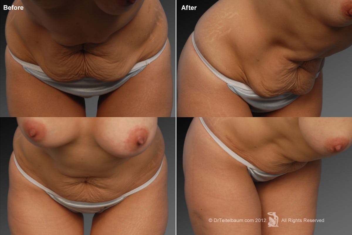 Tummy Tuck Before & After Gallery - Patient 105836420 - Image 1
