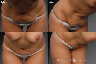 Tummy Tuck Before & After Gallery - Patient 105836420 - Image 1
