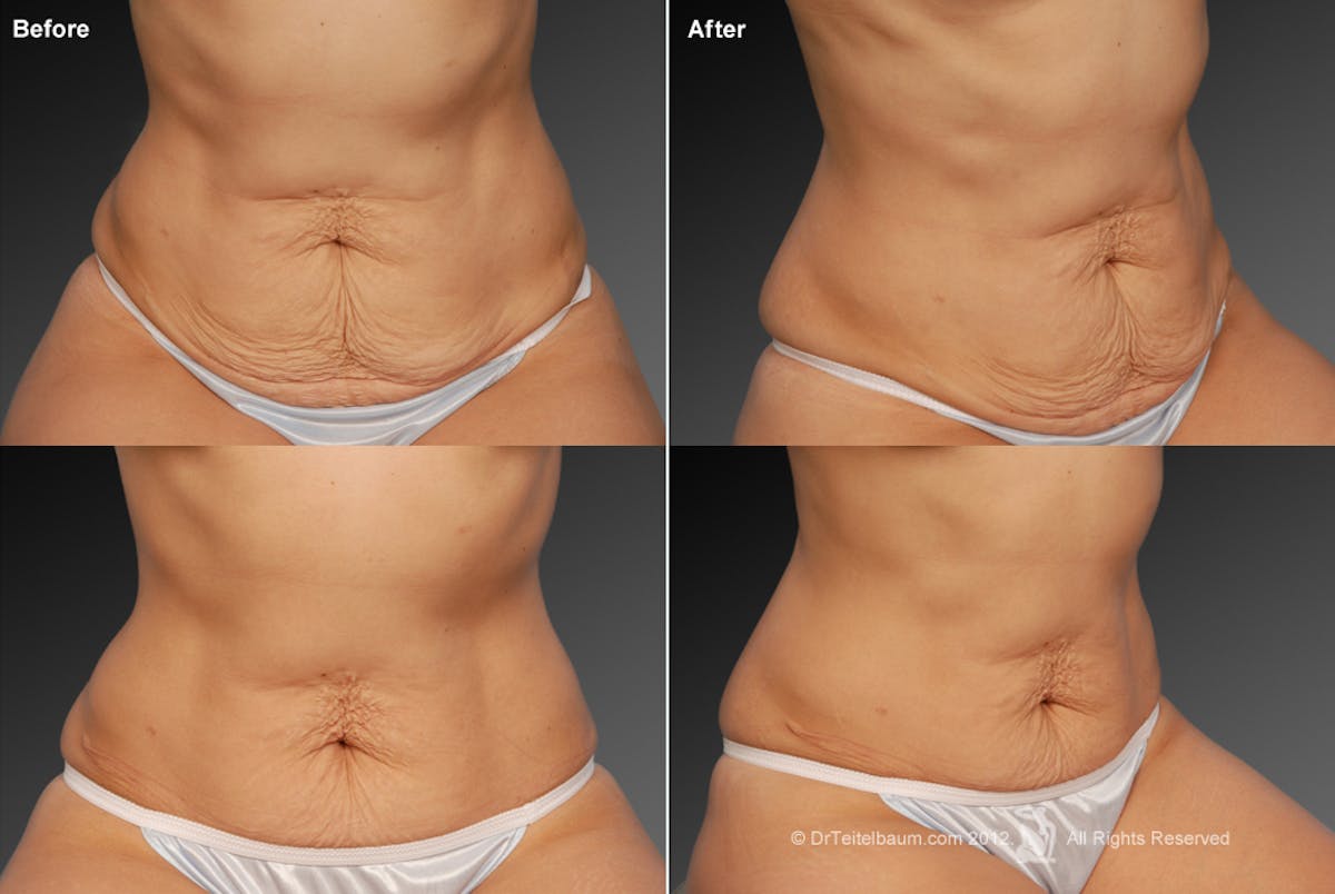 Tummy Tuck Before & After Gallery - Patient 105836421 - Image 1
