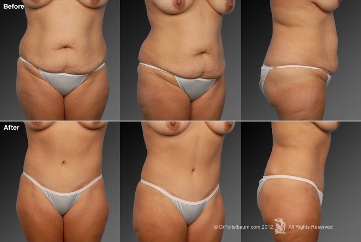 Tummy Tuck Before & After Gallery - Patient 105836423 - Image 1