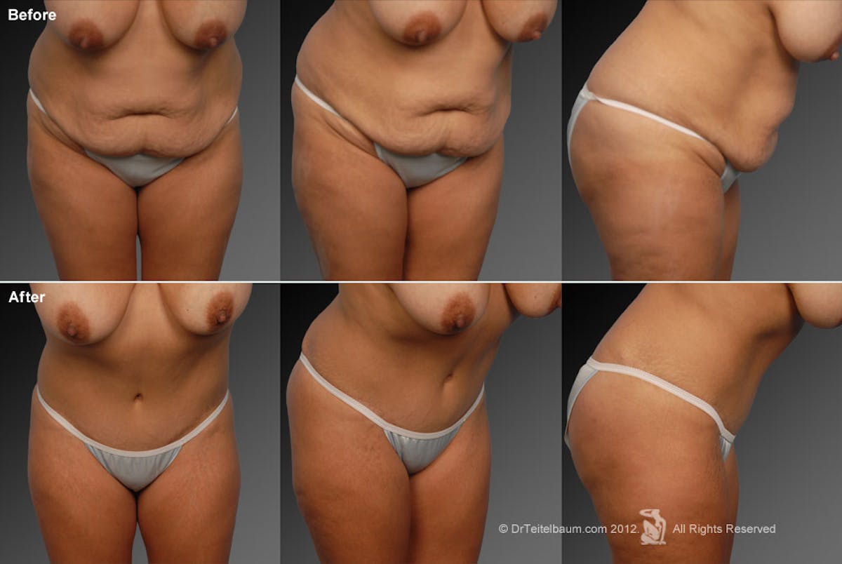Tummy Tuck Before & After Gallery - Patient 105836424 - Image 1