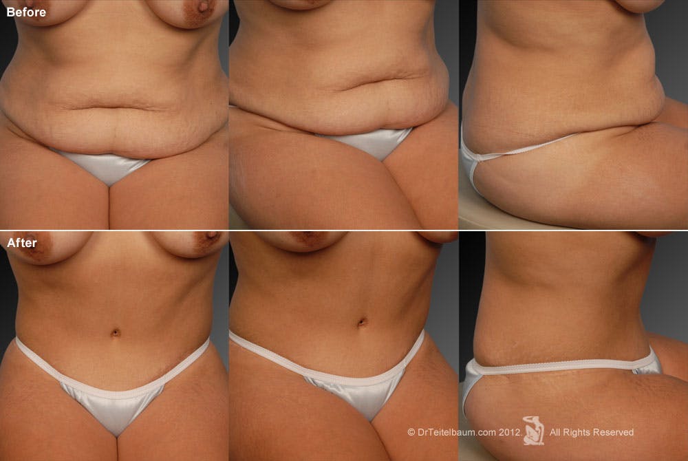 Tummy Tuck Before & After Gallery - Patient 105836425 - Image 1