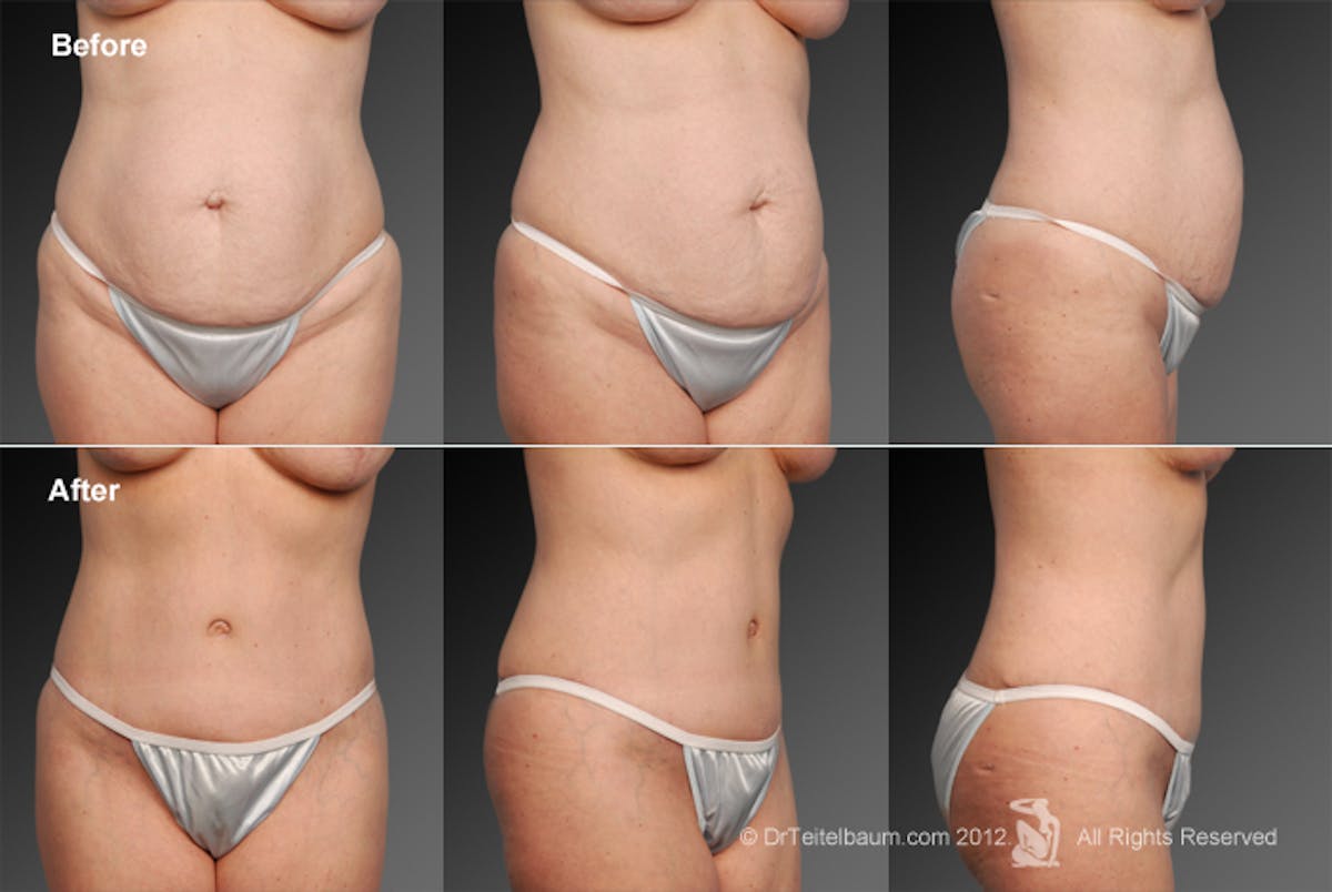 Tummy Tuck Before & After Gallery - Patient 105836426 - Image 1