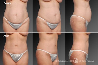 Tummy Tuck Before & After Gallery - Patient 105836426 - Image 1