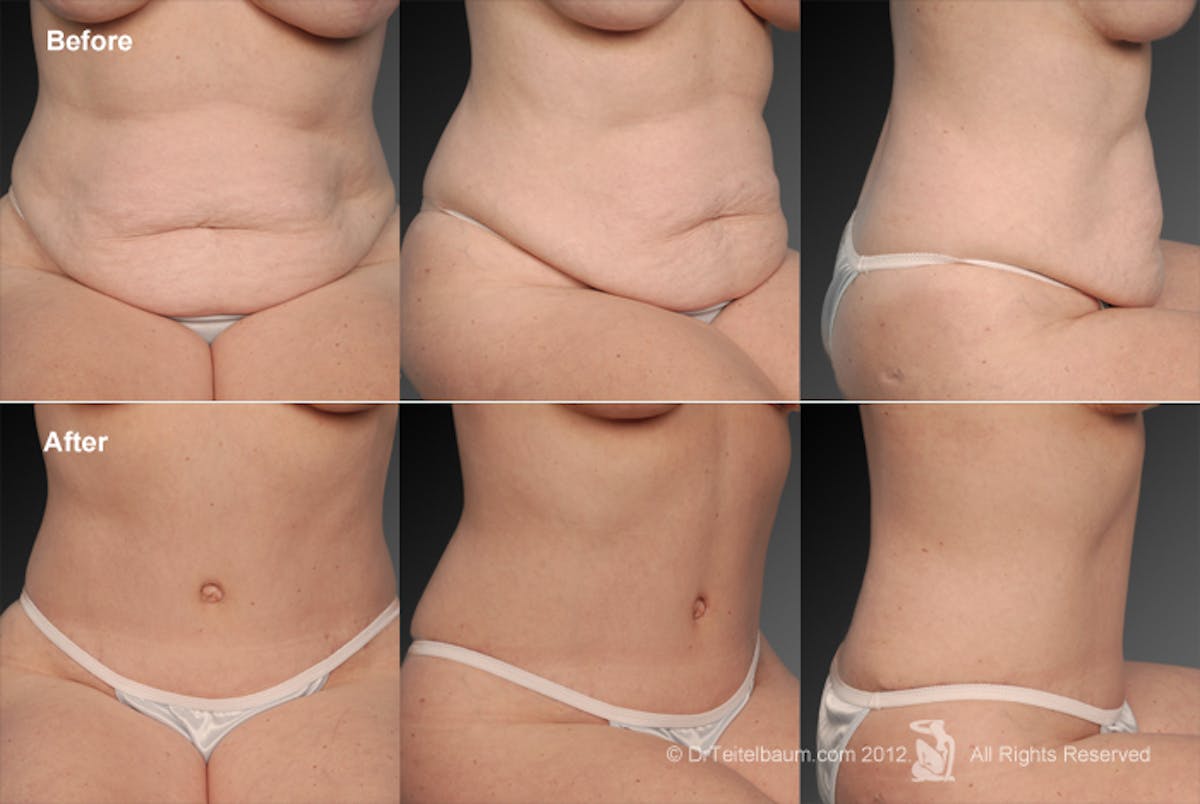 Tummy Tuck Before & After Gallery - Patient 105836430 - Image 1