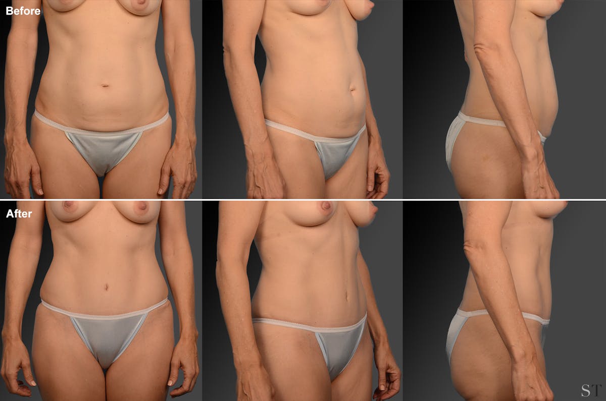 Tummy Tuck Before & After Gallery - Patient 105836432 - Image 1