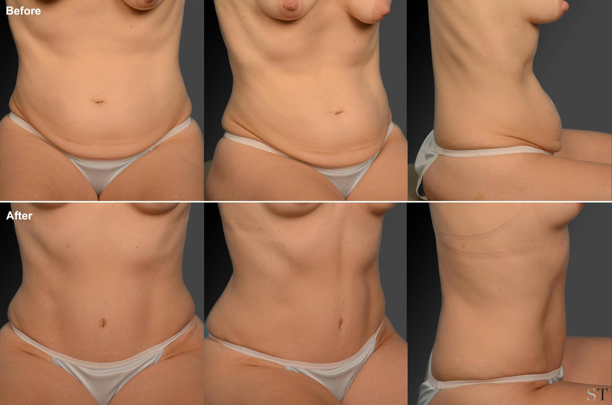 Tummy Tuck Before & After Gallery - Patient 105836433 - Image 1