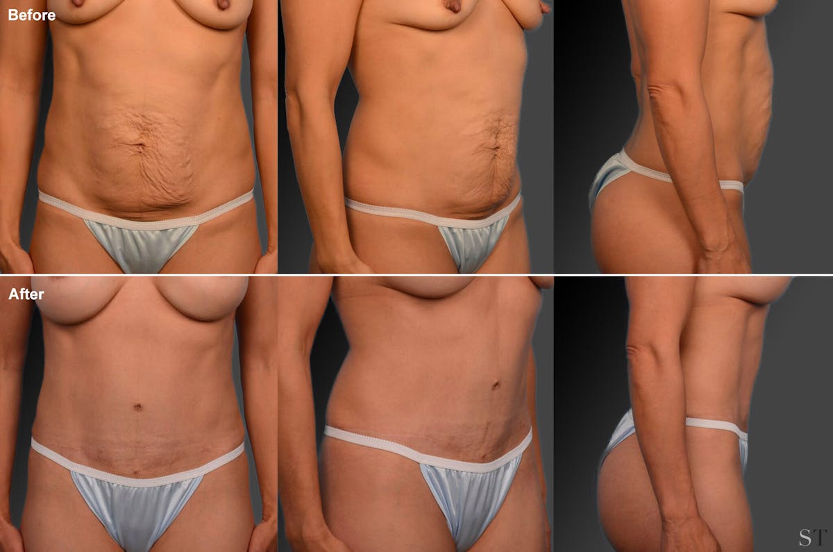 Tummy Tuck Before & After Gallery - Patient 105836435 - Image 1