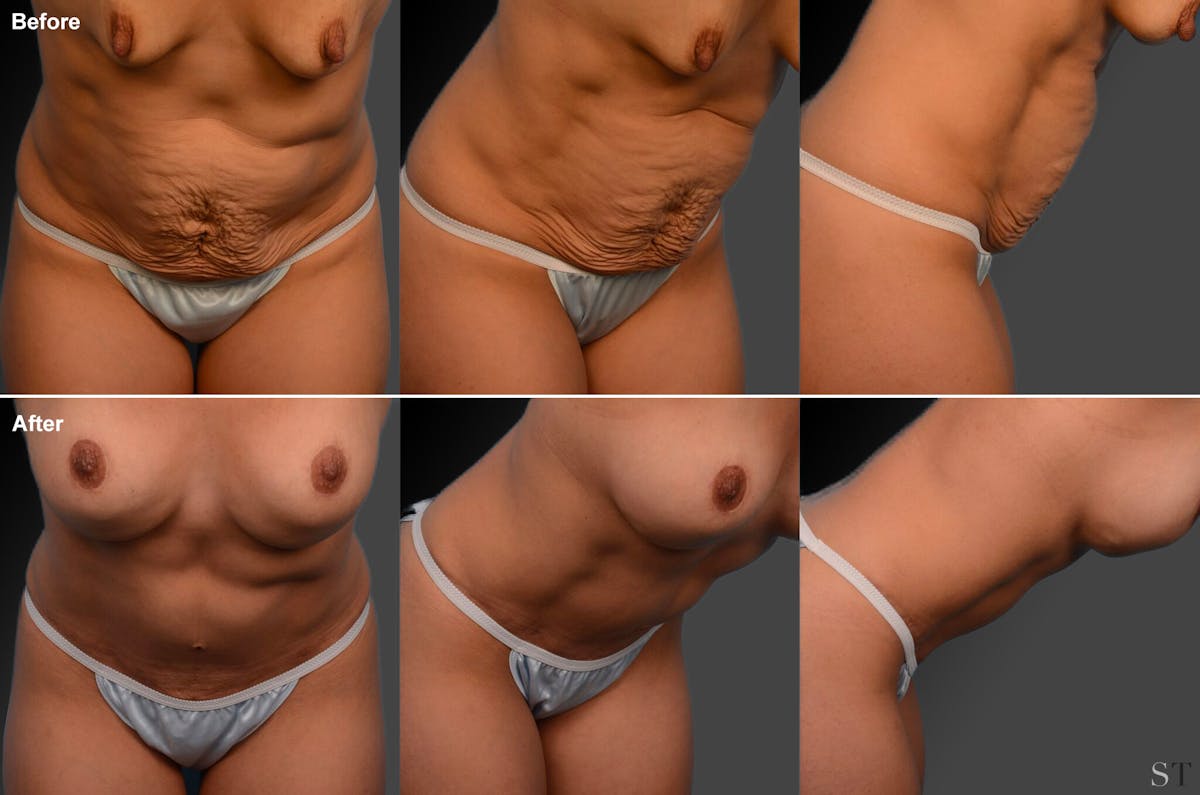 Tummy Tuck Before & After Gallery - Patient 105836444 - Image 1