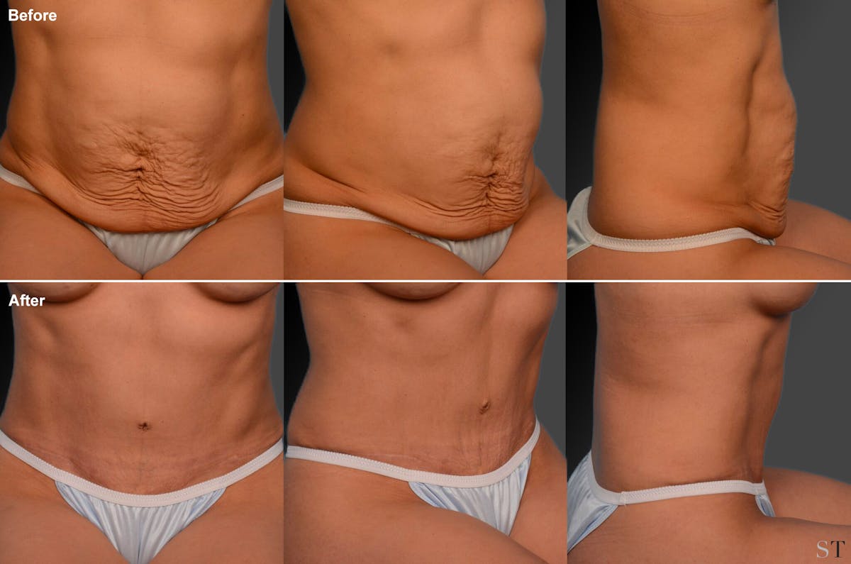 Tummy Tuck Before & After Gallery - Patient 105836445 - Image 1