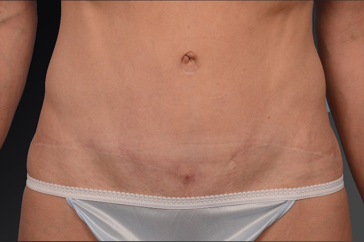 Tummy Tuck Before & After Gallery - Patient 105836447 - Image 1