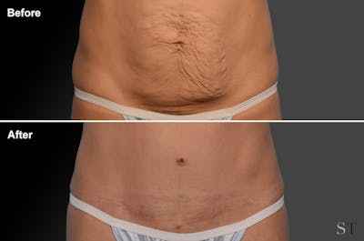 Tummy Tuck Before & After Gallery - Patient 105840710 - Image 1