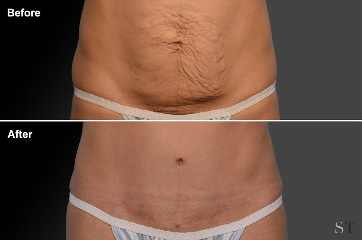 Tummy Tuck Before & After Gallery - Patient 105840710 - Image 1