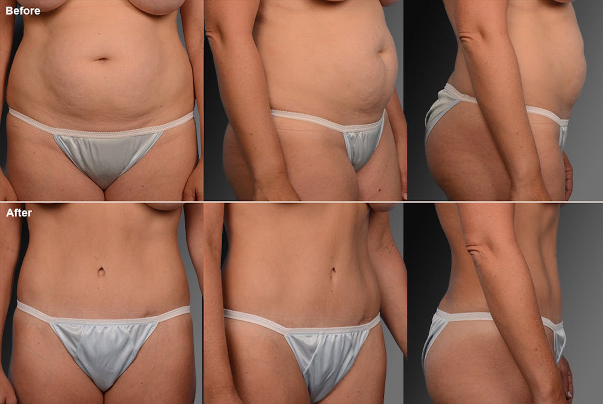 Tummy Tuck Before & After Gallery - Patient 105840711 - Image 1