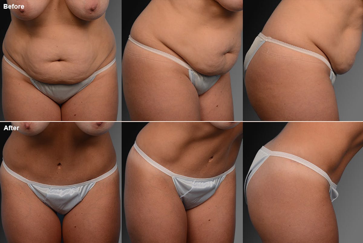 Tummy Tuck Before & After Gallery - Patient 105840712 - Image 1