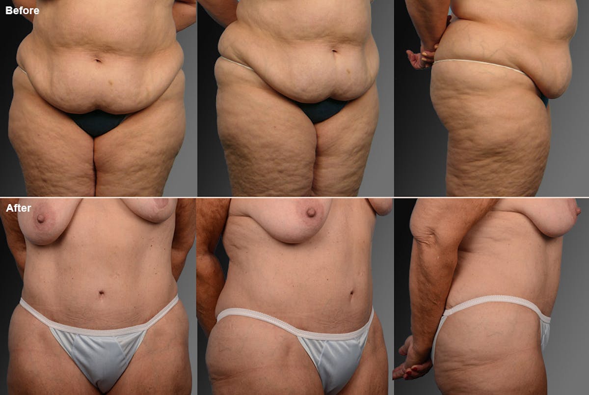 Tummy Tuck Before & After Gallery - Patient 105840718 - Image 1