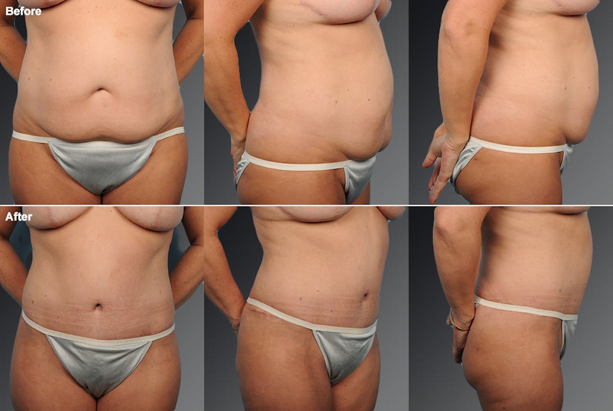 Tummy Tuck Before & After Gallery - Patient 105840719 - Image 1